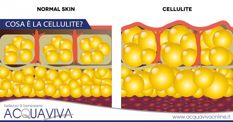 Cosa è la cellulite?