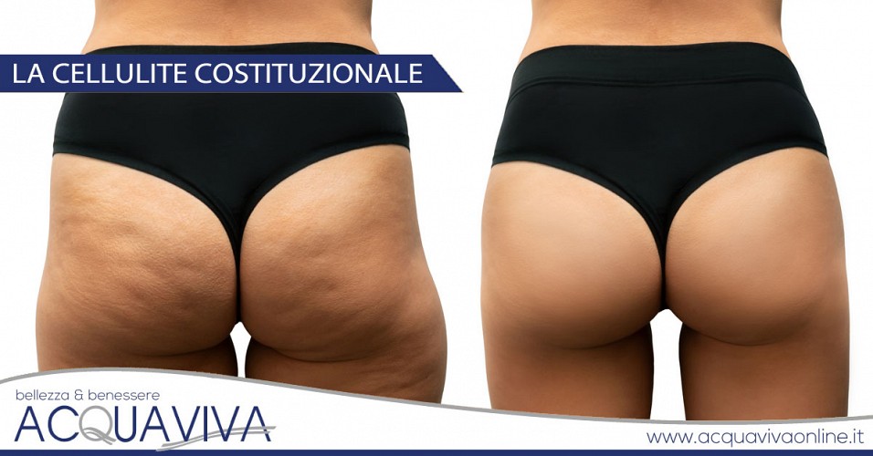 La cellulite costituzionale