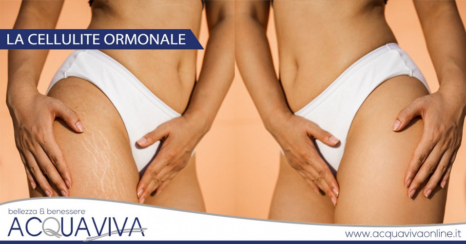 La cellulite ormonale