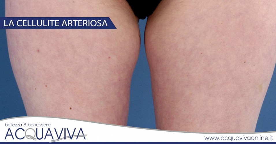 La cellulite arteriosa
