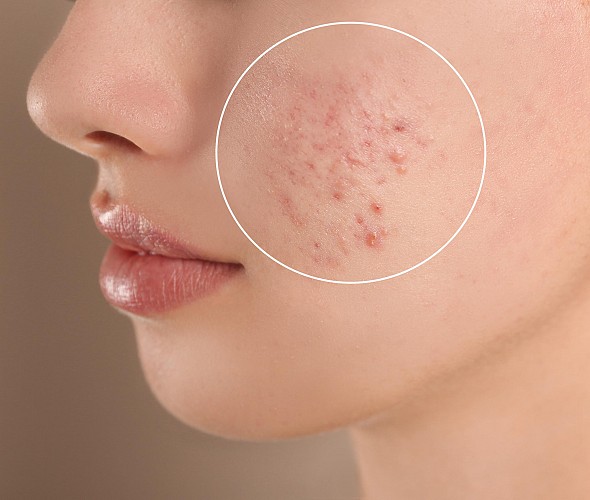 Acne e il metodo Cromalights: un approccio integrato per trattarla con risultati sorprendenti