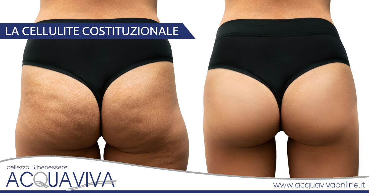 La cellulite costituzionale